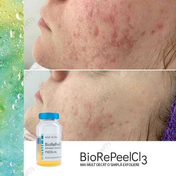 bio re peel 5