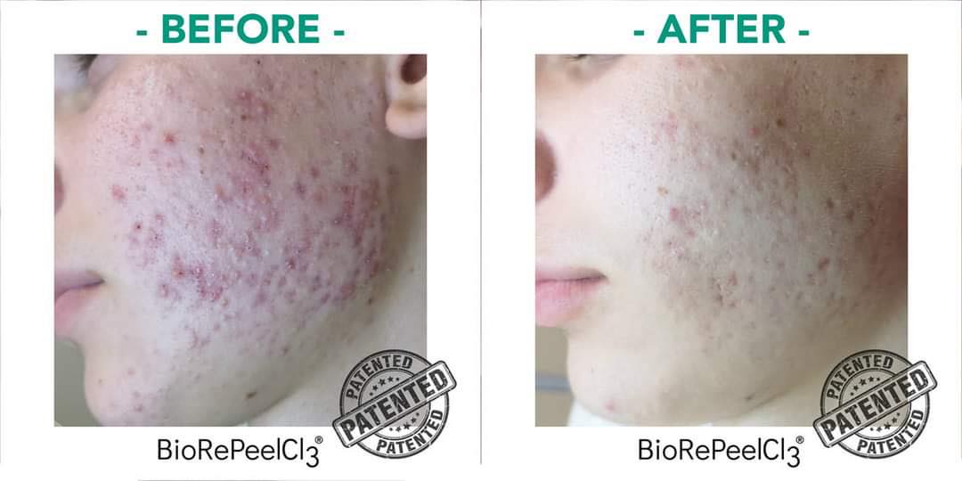 bio re peel 6